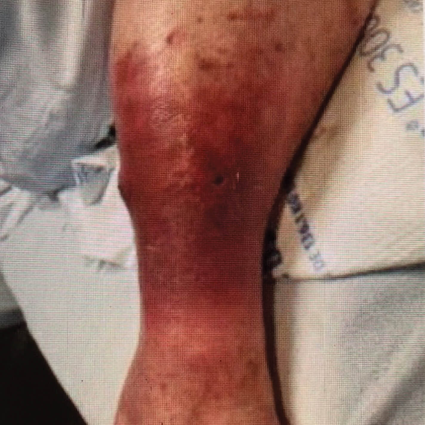 Before image of patient's skin showing initial presentation