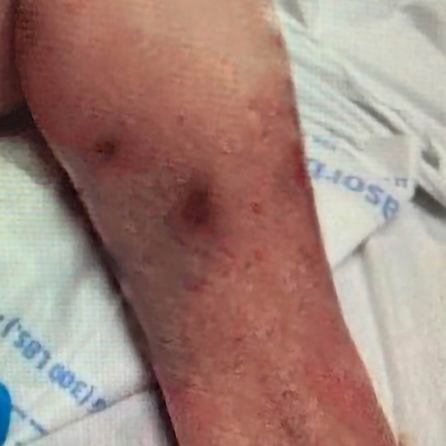 After image of patient's skin showing the final healed wound at 2-week follow-up