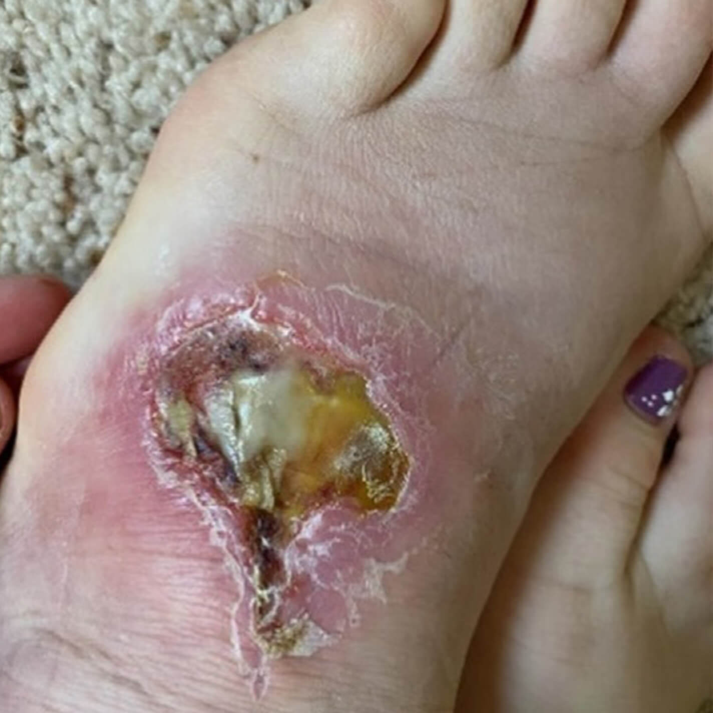 Before image of a patient's foot showing initial presentation.
