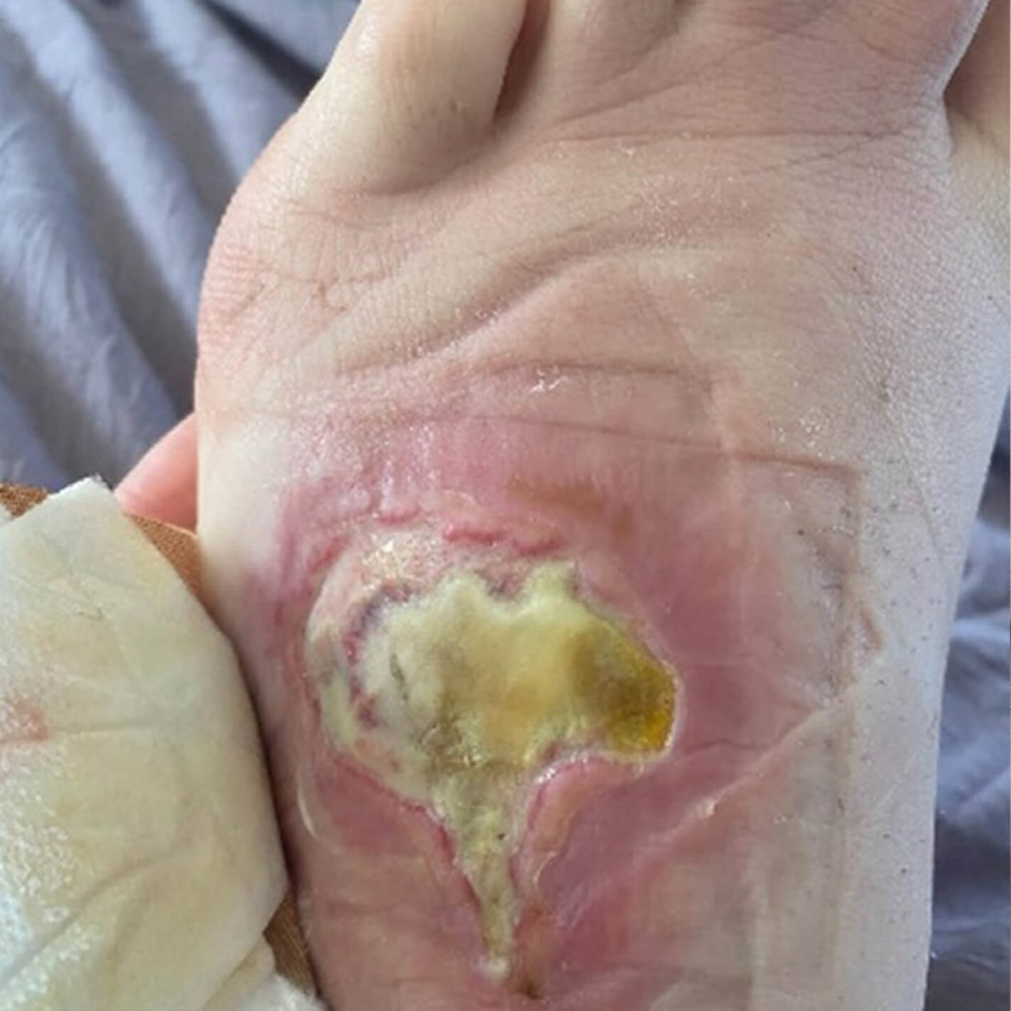 Image of a patient's foot showing changes at 1 week after course of treatment.