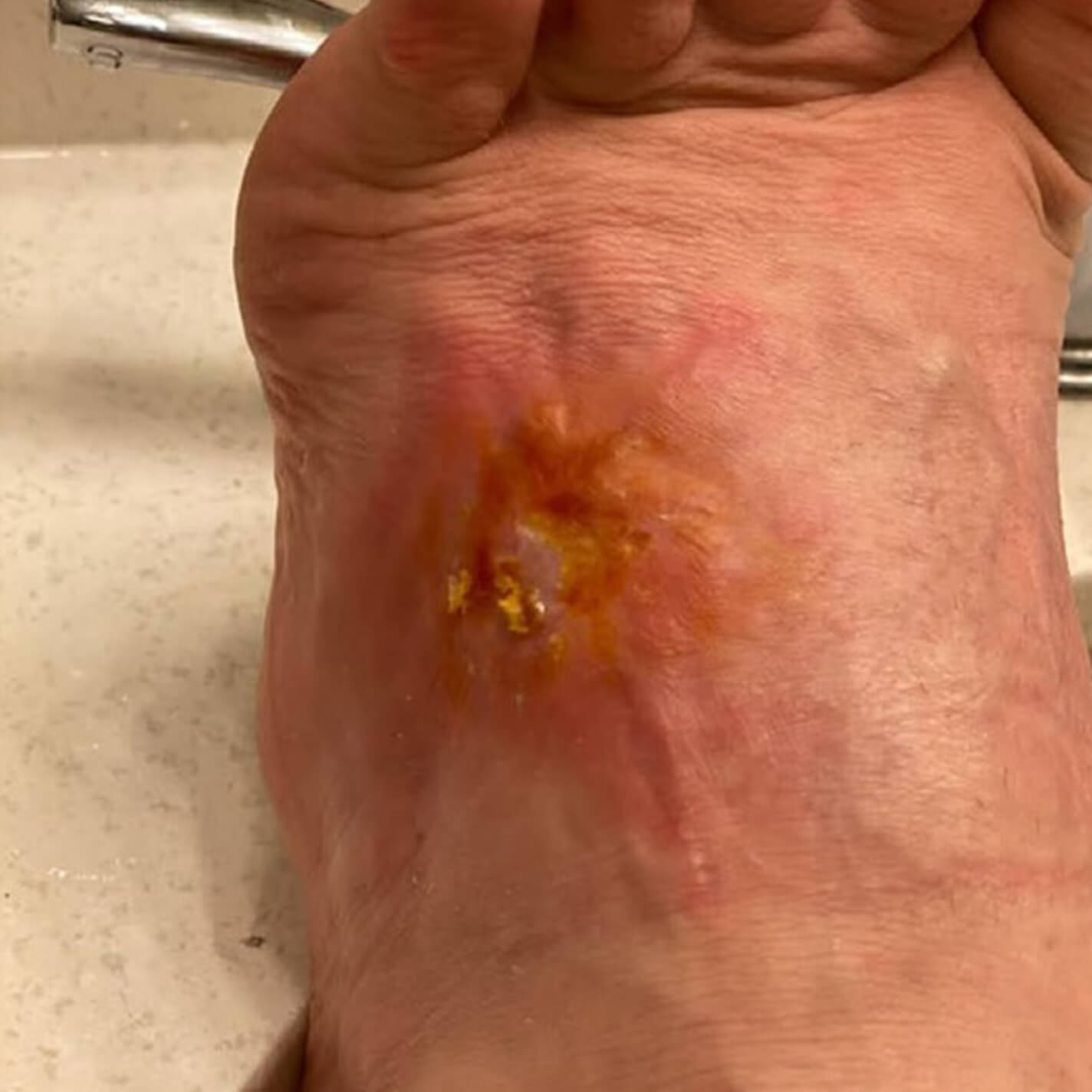 After image of a patient's foot showing final healed wound after 3 months.