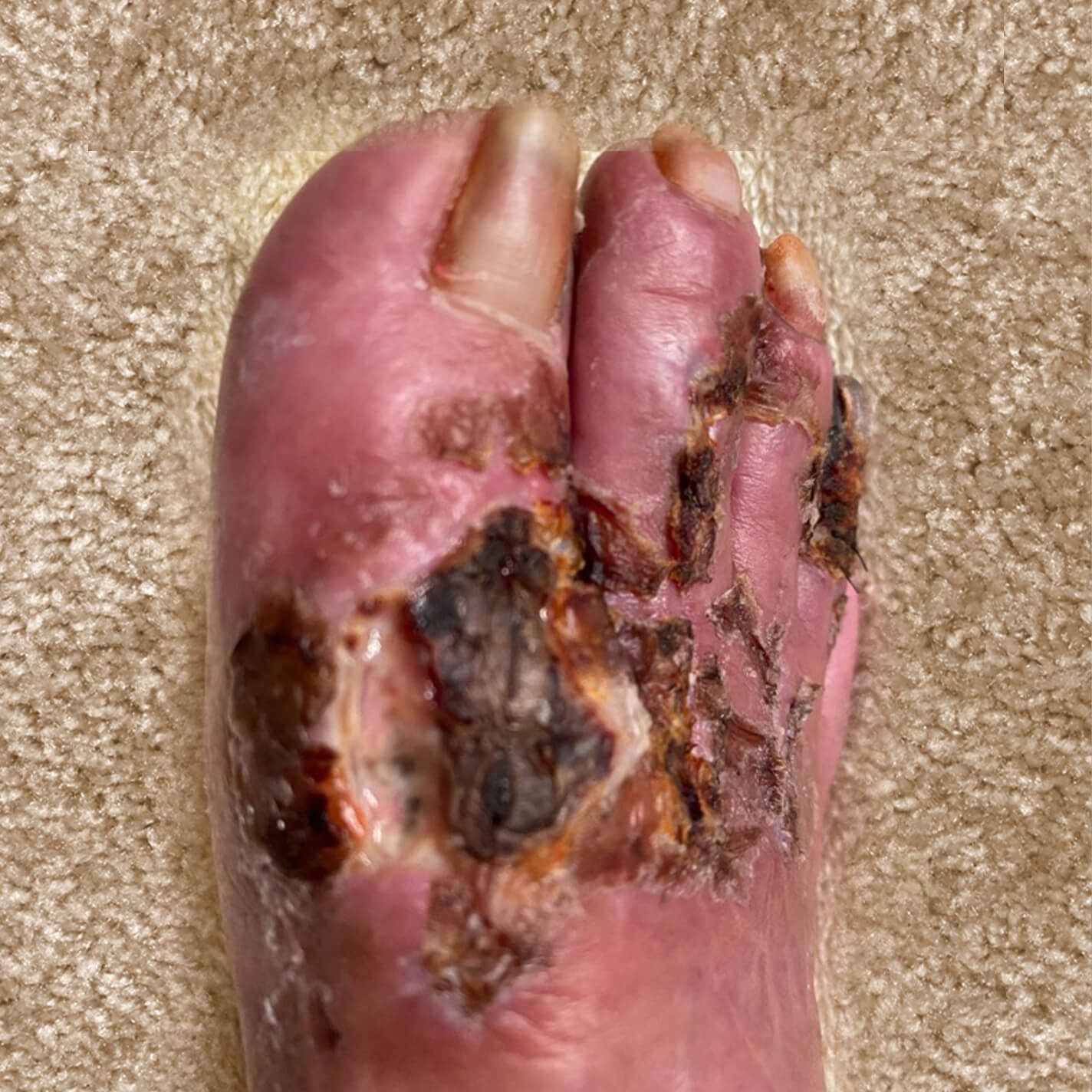 Before image of a patient's foot showing initial cellulitis presentation.