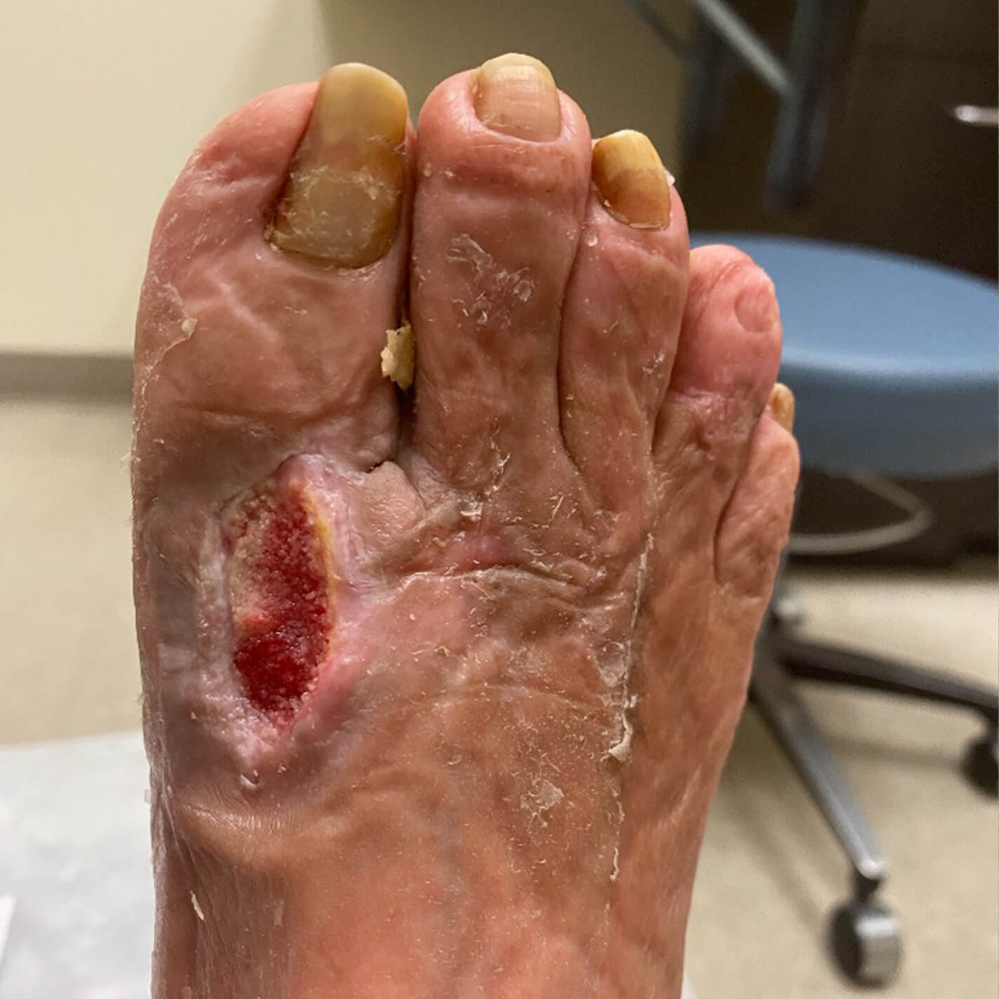 Image of a patient's foot showing changes during the course of treatment.