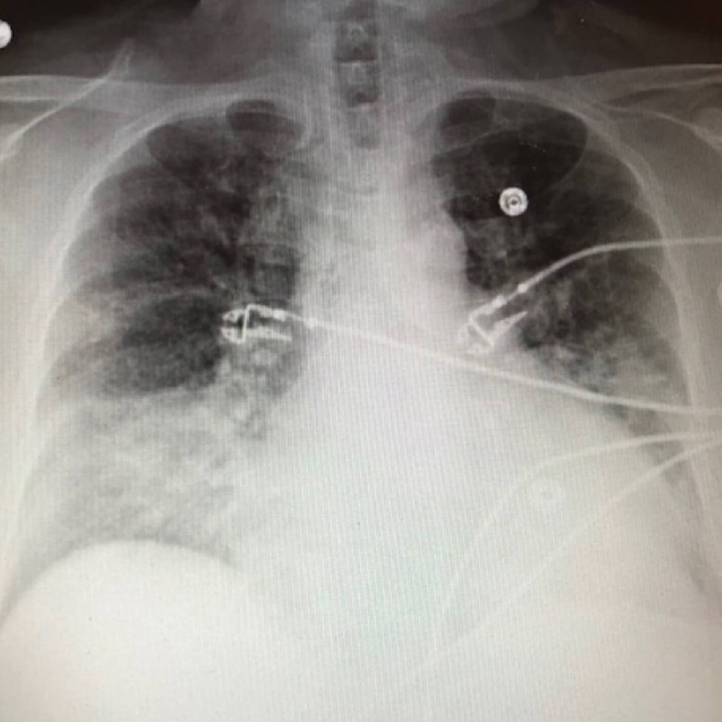 Before image of an initial chest x-ray.