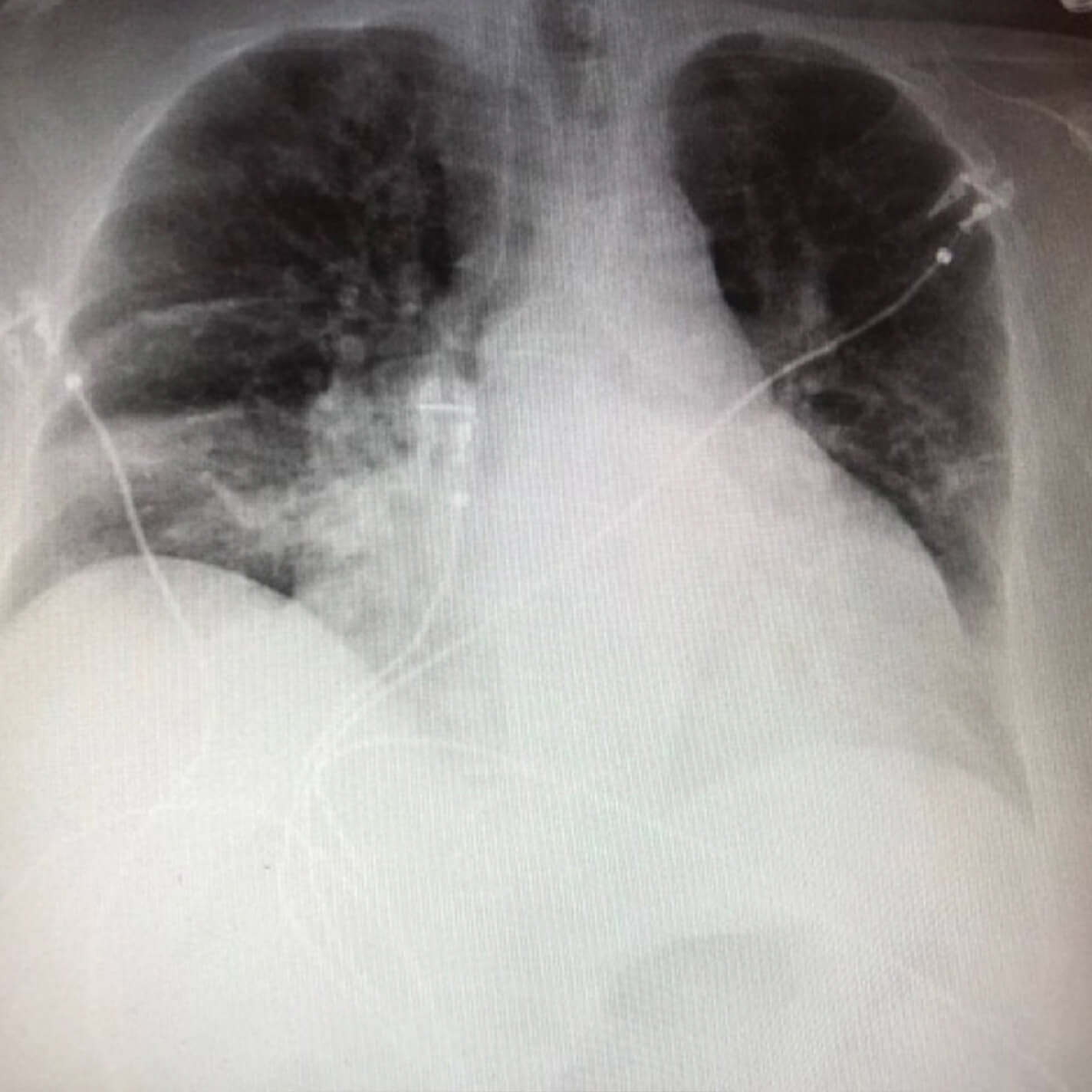 After image of a follow-up chest x-ray (after 28 days)