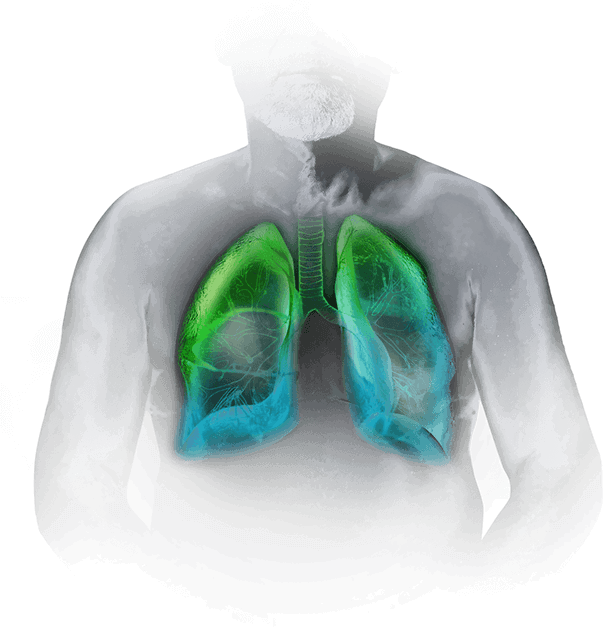A graphic illustration portraying a patient with community-acquired bacterial pneumonia representing S. pneumoniae pathogen